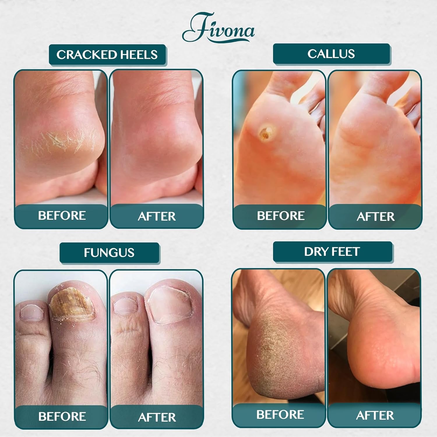 Tea Tree Foot Soak Blend 14.1 Oz - Epsom Salt with Essential Oils for Healthy Toenails, Soothing Relief, Callus Softening - Pedicure Therapy for Soft, Rejuvenated Feet