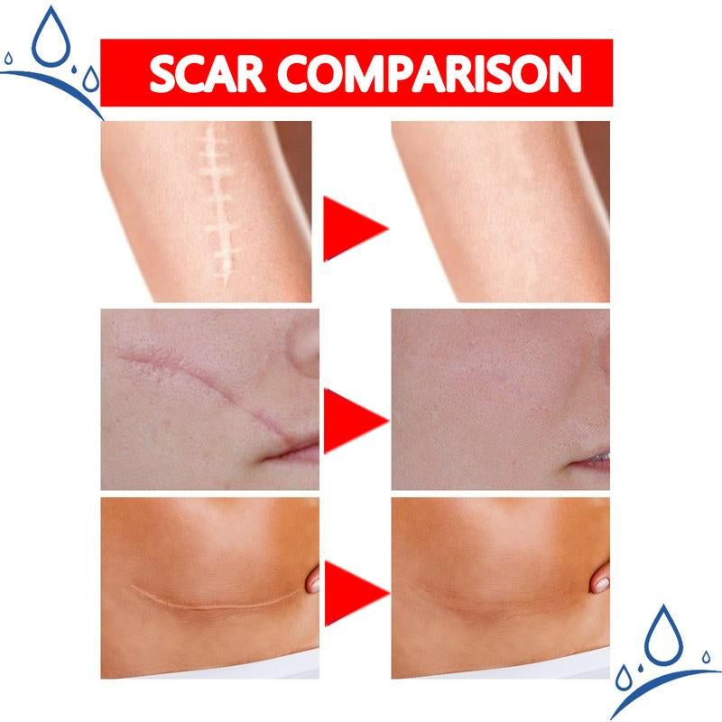 Professional Scar Removal Gel - Suitable for Acne Scars, Black Spots, Surgery, Cesarean Section, Burns, Acne and Other Scar Removal Treatment